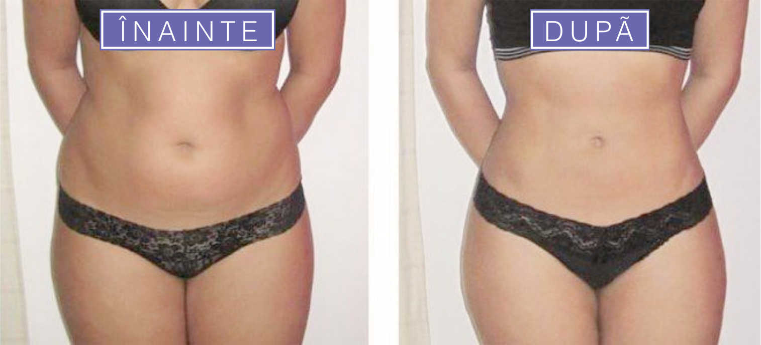 vacuslim 48 president spa center baile felix